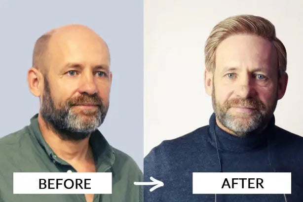 Men’s Non-Surgical Hair Replacement Before and After